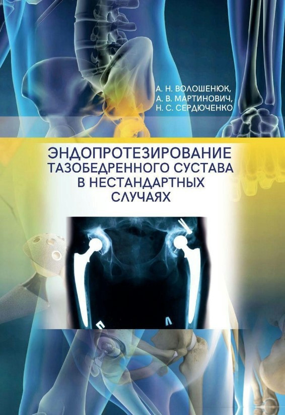 Книга “Ендопротезування кульшового суглоба у нестандартних випадках” – Волошенюк О.